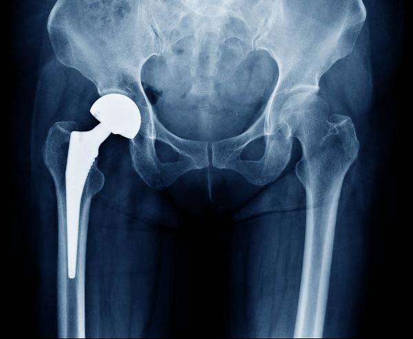 xray of a hip replacement