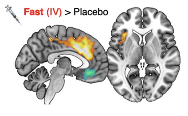 cross section of a brain showing  active regions in yellow and green