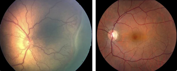 Left: Image of a premature infant’s retina showing signs of severe ROP with large, twisted blood vessels; Right: an infant’s healthy, typical retina.