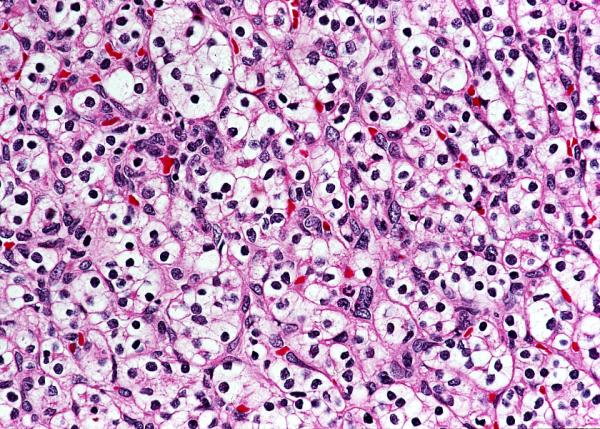This image from Dr. Linehan’s lab shows cells affected by clear cell kidney cancer.