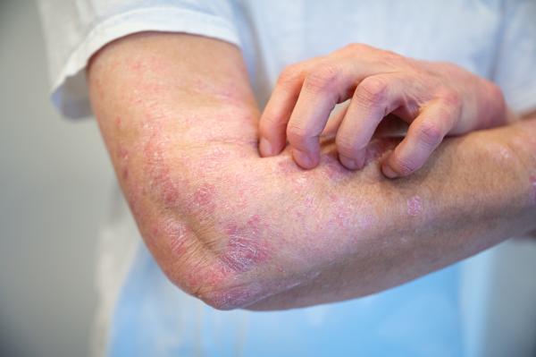 person with rash from psoriasis