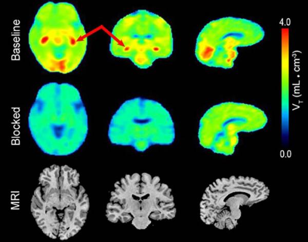 PET brain scan showing areas of inflammation in the brain and decreased inflammation after drug treatment