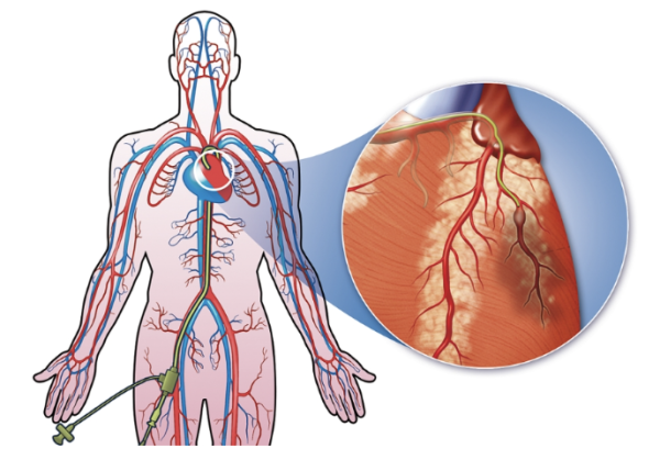 illustration of catheter threaded through leg to the heart