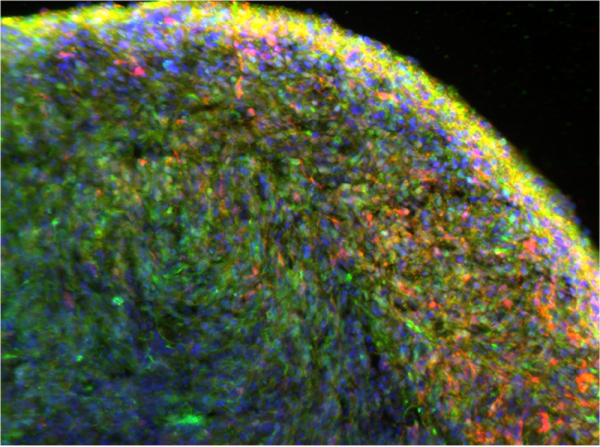 A close-up view of organoids developed by Dr. Zheng’s team, showing neurons in red and alpha-synuclein in green