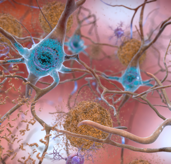 neurons containing abnormal tau (blue) and surrounded by amyloid-beta plaques (brown)