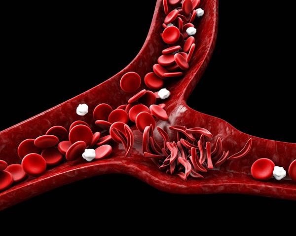 normal and sickled red blood cells