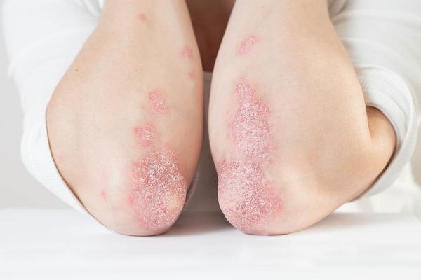 skin rash caused by psoriasis