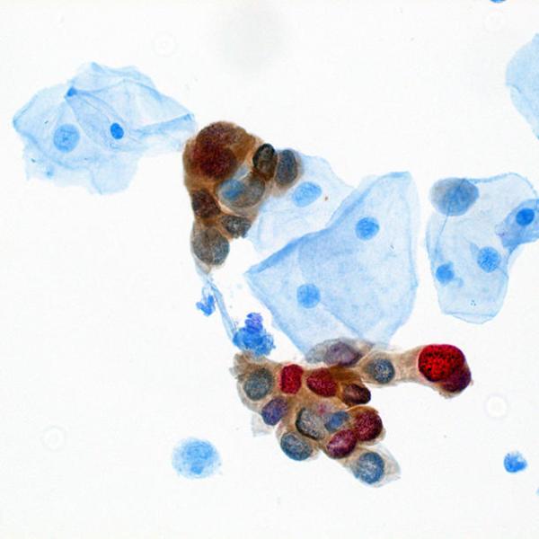 a ‘dual-stain’ test shows the presence of two proteins, p16 (brown) and Ki-67 (red), in cervical cells