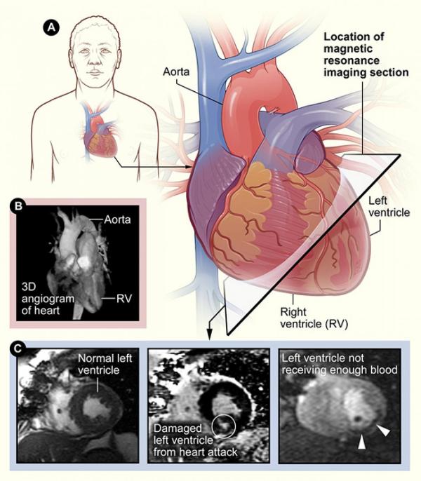 diagram of the human heart next to MRI images of the heart