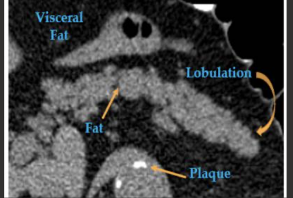 Pancreatic computed tomography scans can help predict type 2 diabetes: Images in a 67-year-old man with type 2 diabetes who was diagnosed 595 days after CT. This pancreas is relatively inhomogeneous due to fatty atrophy, lobulated, and irregular in contour.