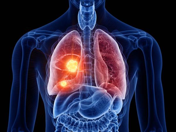 tumors in the lungs