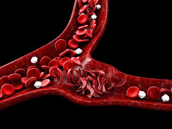 sickled red blood cells clumping up in a blood vessel