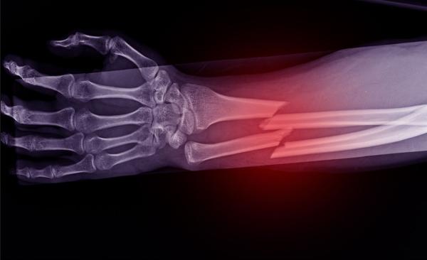 x-ray of a broken arm