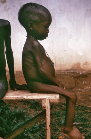 a child with kwashiorkor, a form of malnutrition