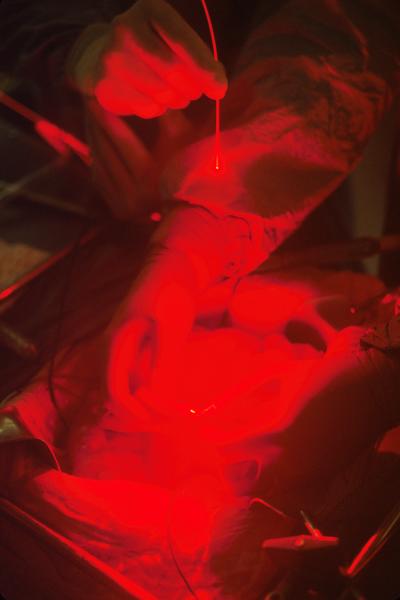 Close up of surgeons' hands in an operating room with a "beam of light" traveling along fiber optics for photodynamic therapy