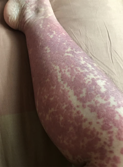 leg rash associated with vasculitis