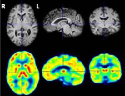 PET scan of the brain showing areas of reduced cAMP activity