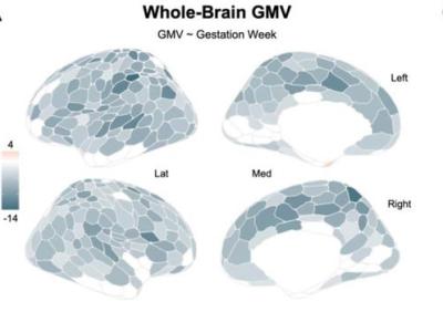 graphic of a brain showing light and dark blue regions representing volume loss