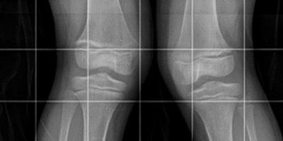 X-ray of genu valgum, or “knock knees,” in a child with rickets.
