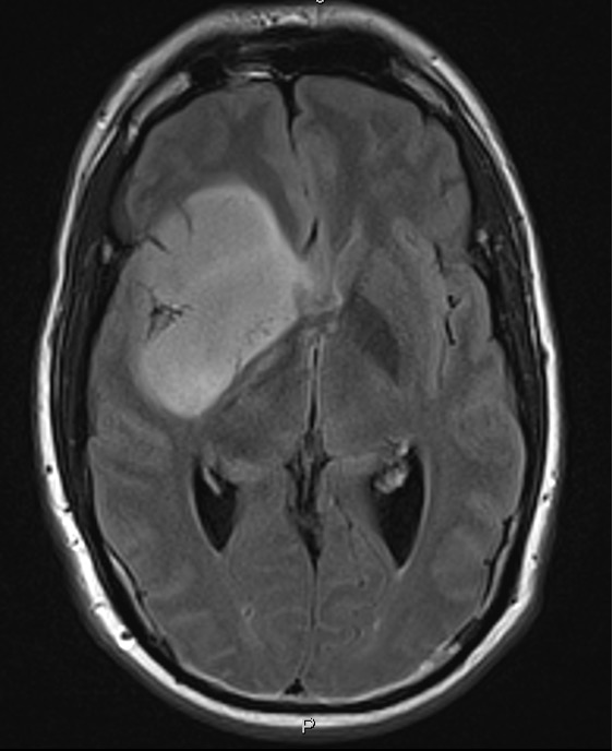 glioma brain tumor
